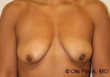 Before & After Breast Augmentation Gallery - Before & After - Dr. Placik