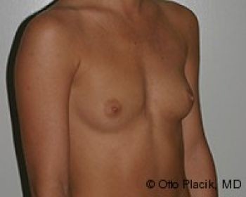 Breast Augmentation Chicago