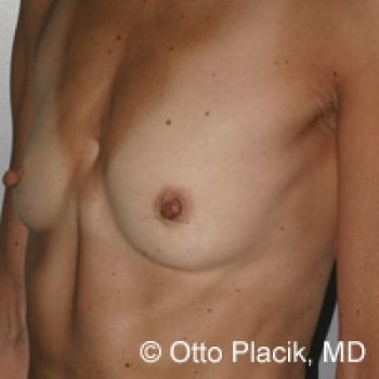 Breast Augmentation