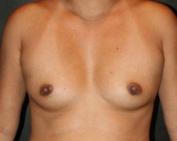 Breast Augmentation