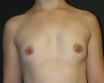 Breast Augmentation with Fat Grafting - Before & After - Dr. Placik