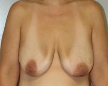 Breast Augmentation with Fat Grafting - Before & After - Dr. Placik