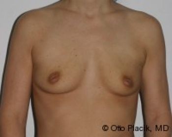 Before & After Breast Augmentation Gallery - Before & After - Dr. Placik