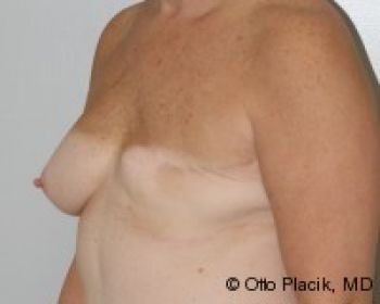 Breast Augmentation with Fat Grafting Chicago