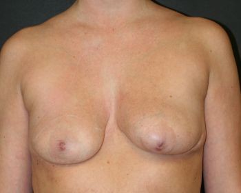 Breast Augmentation with Fat Grafting - Before & After - Dr. Placik