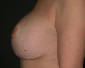 Nipple Repair - Before & After - Dr. Placik