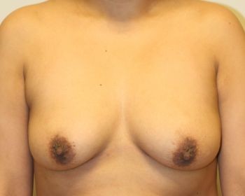 Breast Augmentation with Lift - Before & After - Dr. Placik