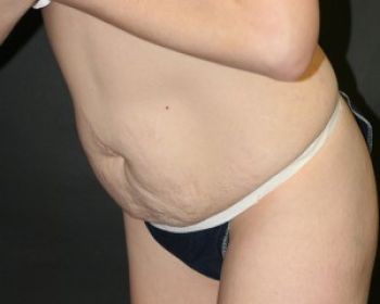 Tummy Tuck Chicago