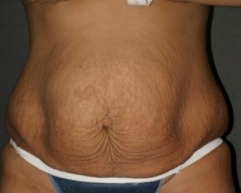 Tummy Tuck Chicago