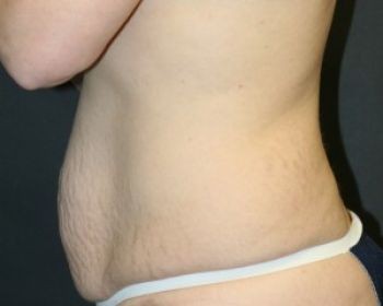 Tummy Tuck Chicago