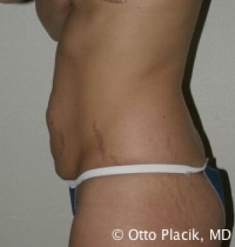 Tummy Tuck Chicago