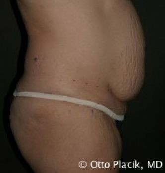 Tummy Tuck Chicago