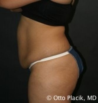 Tummy Tuck Chicago