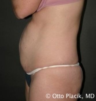 Tummy Tuck Chicago