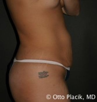 Tummy Tuck Chicago