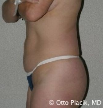 Tummy Tuck Chicago