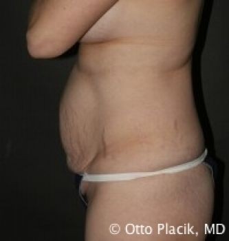 Tummy Tuck Chicago