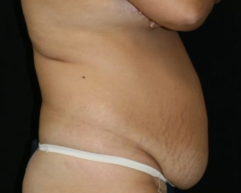 Tummy Tuck Chicago