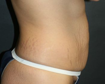 Tummy Tuck Chicago