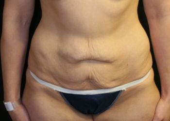 Tummy Tuck - Before & After - Dr. Placik