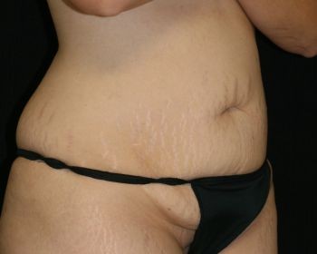 Tummy Tuck