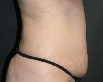 Tummy Tuck