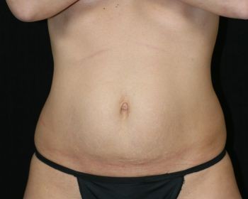 Tummy Tuck - Before & After - Dr. Placik