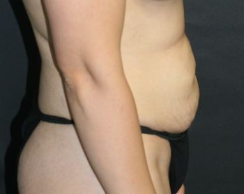 Tummy Tuck - Before & After - Dr. Placik