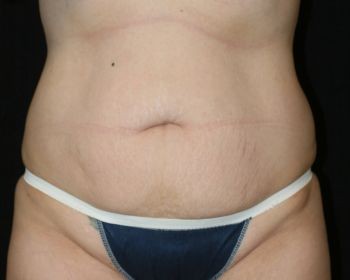 Tummy Tuck - Before & After - Dr. Placik