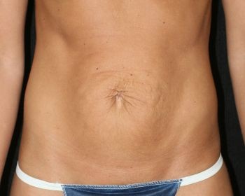 Tummy Tuck - Before & After - Dr. Placik