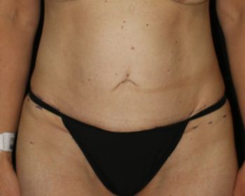 Tummy Tuck - Before & After - Dr. Placik