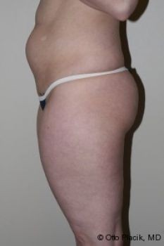 Liposuction Chicago