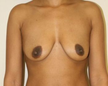 Before & After Breast Augmentation Gallery - Before & After - Dr. Placik