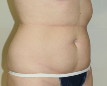 Liposuction Chicago