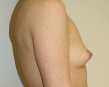 Breast Augmentation Chicago