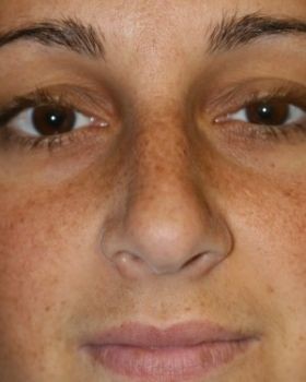 Rhinoplasty Chicago