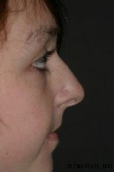 Rhinoplasty Chicago