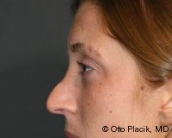 Rhinoplasty - Before & After - Dr. Placik