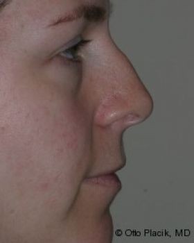 Rhinoplasty - Before & After - Dr. Placik