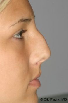 Rhinoplasty - Before & After - Dr. Placik