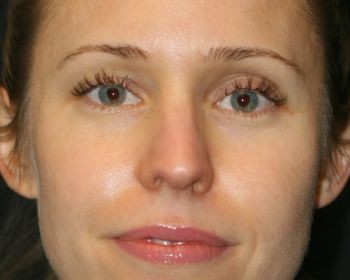 Rhinoplasty Chicago