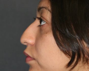 Rhinoplasty - Before & After - Dr. Placik