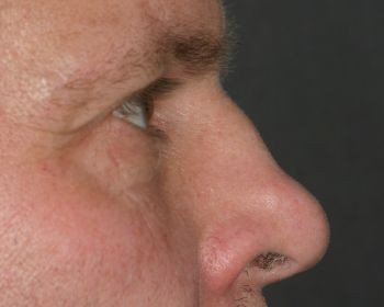 Non-Surgical Rhinoplasty - Before & After - Dr. Placik