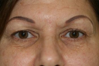 Eyelid Surgery - Before & After - Dr. Placik