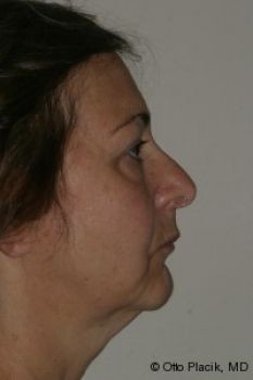 Eyelid Surgery - Before & After - Dr. Placik