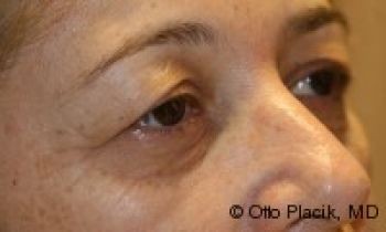 Eyelid Surgery - Before & After - Dr. Placik