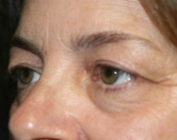 Eyelid Surgery - Before & After - Dr. Placik