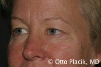 Eyelid Surgery - Before & After - Dr. Placik