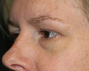 Eyelid Surgery - Before & After - Dr. Placik