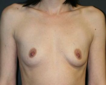 Before & After Breast Augmentation Gallery - Before & After - Dr. Placik